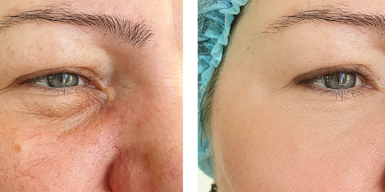 Dermapen Tedavi Dr. Bülent Kurt
